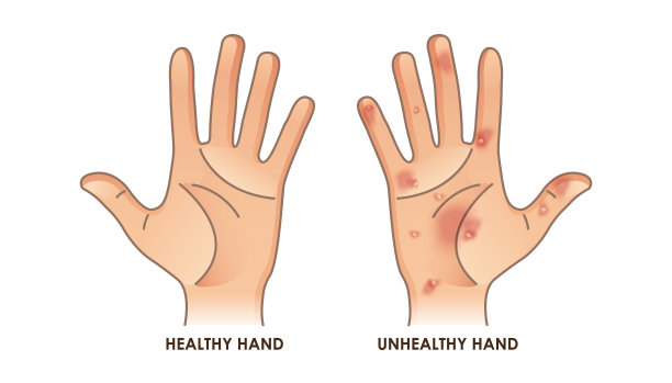 健康和不健康的手矢量插图图片下载