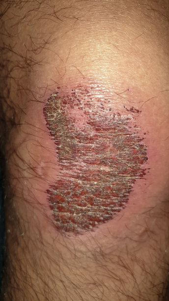 膝盖伤口结痂图片下载