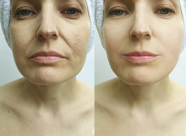 女性面部皱纹治疗前后素材图片