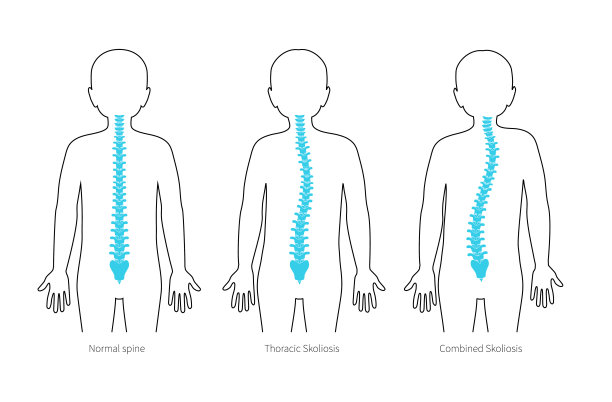 脊柱侧凸平面矢量图图片下载