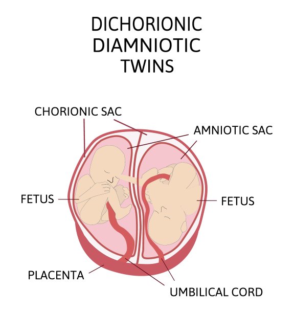 双胞胎腹部解剖。平面设计中的双类型信息图表元素。双胎同卵或异卵胎盘图片下载
