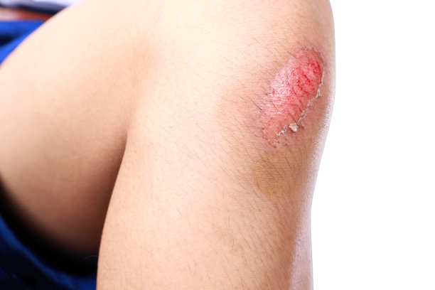 一个亚洲男孩在足球比赛中意外受伤，膝盖擦伤或受伤。在白色背景上隔离运行事故后出血擦伤的闭合。图片下载