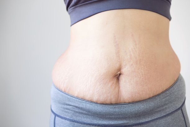 孕妇腹部皮肤造成条纹状脂肪和疤痕图片下载