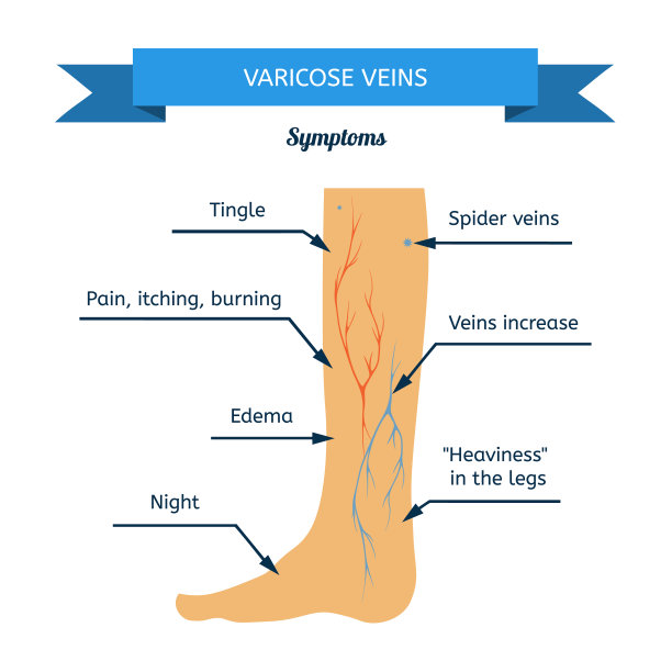 静脉曲张的症状。女人的腿与静脉的轮廓图片下载