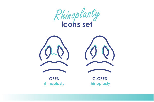 鼻整形术。开放式和封闭式鼻整形术。鼻子整形手术。底部视图。医学和美容插画图片下载