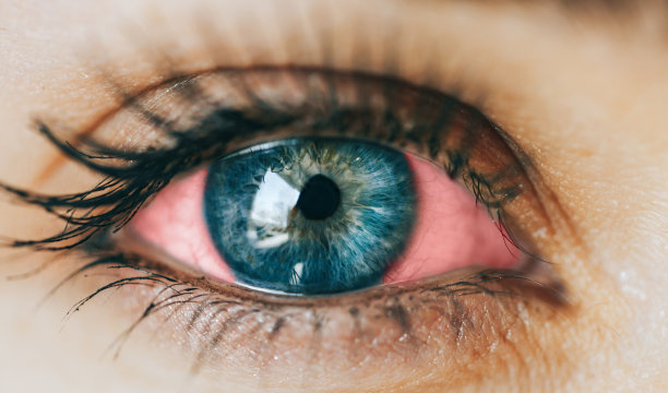 眼睛发红的病人图片下载