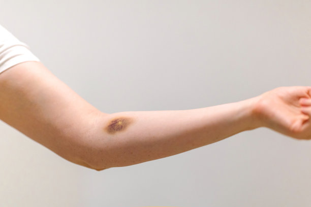 擦伤的急救。手臂上有大片血肿和擦伤，还有绷带图片下载