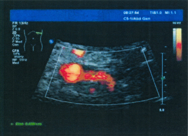 肾动脉彩色多普勒超声医学检查图像图片下载