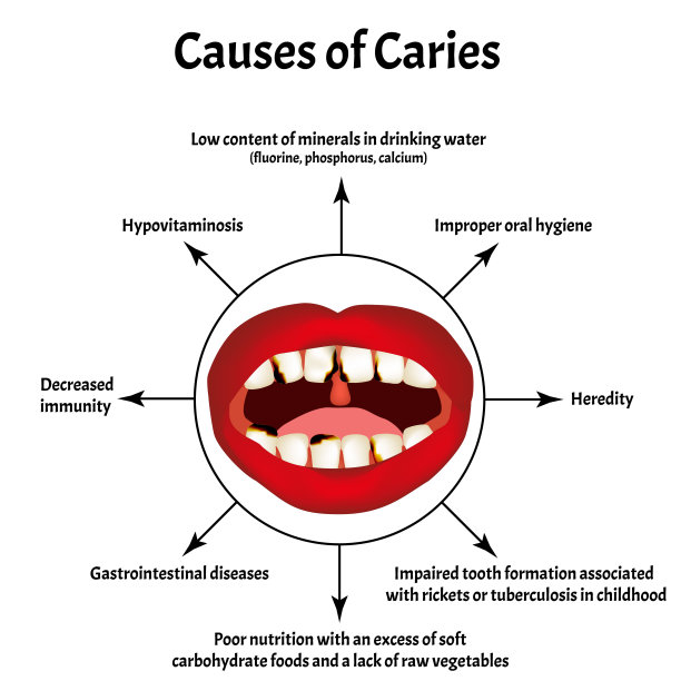 龋齿的原因。从嘴里闻。口臭。牙齿和口腔的结构牙齿疾病。信息图。矢量插图在孤立的背景。图片下载