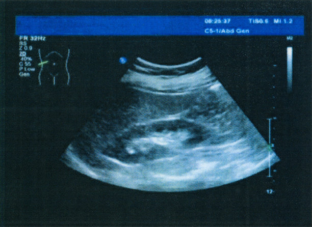 肝、胆、胰、脾、肾、肾上腺彩色多普勒超声医学检查图像图片下载