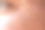Milia (Milium) -眼睛周围的粉刺。眼睑上有小乳头状瘤或皮肤上有增生的年轻人的眼睛。图片下载
