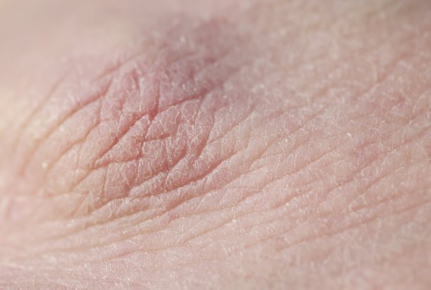 背景与纹理粉红色风化的人类手皮肤覆盖着深皱纹和干燥鳞片图片下载