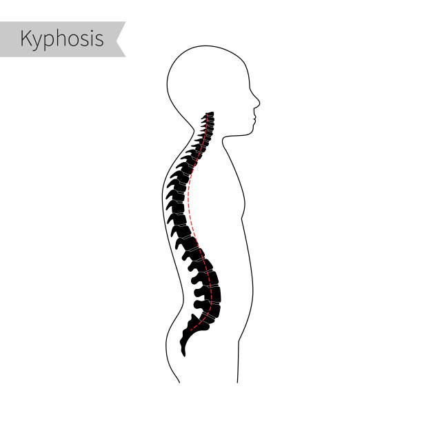 后凸扁平矢量图解。图片下载