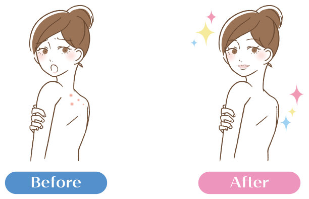 背部痤疮疤痕毛孔脏女人后bifor图片下载