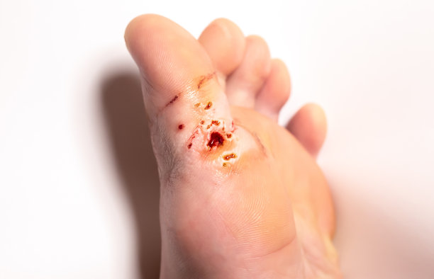 激光去除疣的痕迹。受伤流血。脚上的皮肤传染病。医疗的照片。图片下载