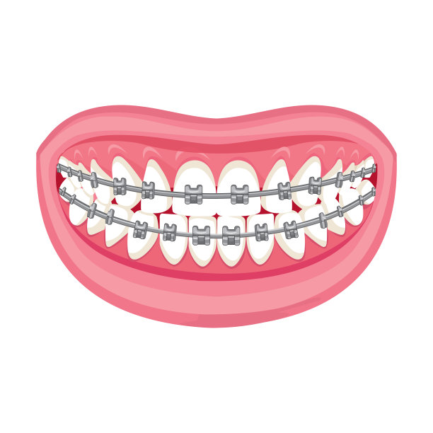牙齿上的牙套，粉红色的嘴唇和洁白的牙齿图片下载