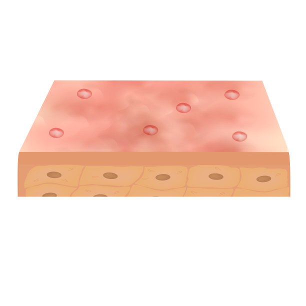 封闭的黑头粉刺。皮肤上的粉刺。皮肤病学和美容疾病对脸上的皮肤痤疮。信息图。矢量插图在孤立的背景。图片下载