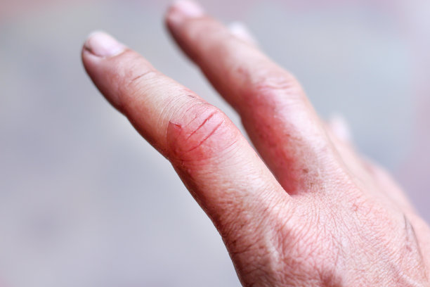 在冠状病毒爆发期间，使用酒精凝胶后右手指妇女的过敏症状图片下载