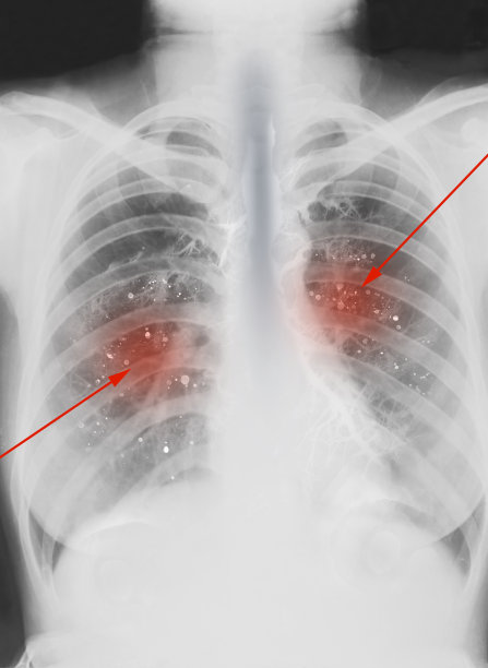 x光片，肺部感染，病毒感染，图片下载
