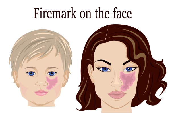 脸上有火印图片下载