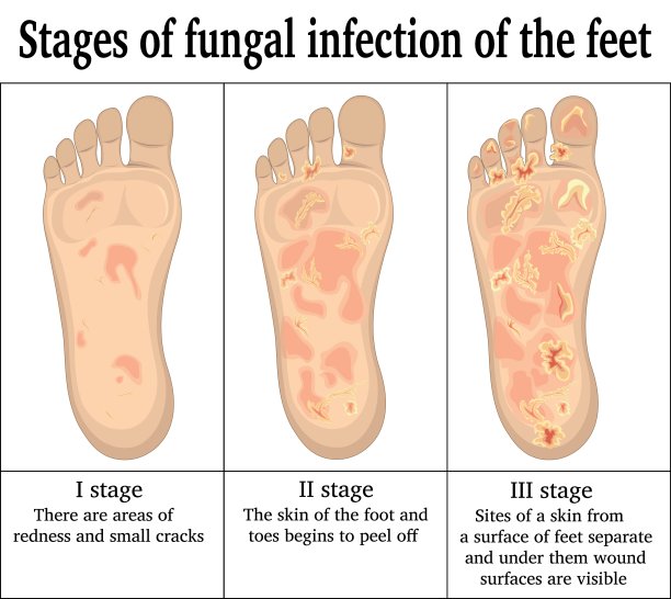 脚部真菌感染图片下载