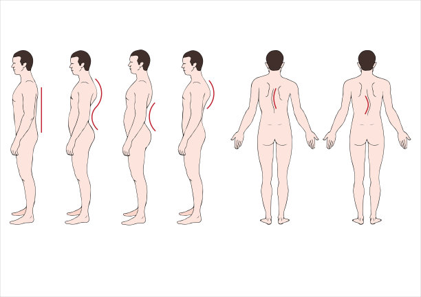 脊柱变形图片下载