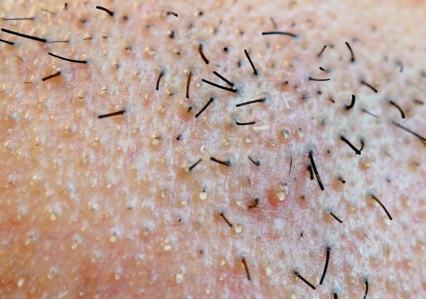 极端特写与存根挤压青春痘图片下载