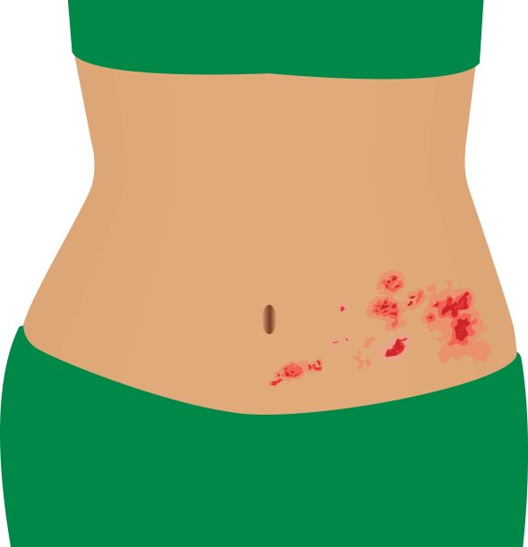 带状疱疹是一个女性身上水痘带状疱疹的载体插图图片下载