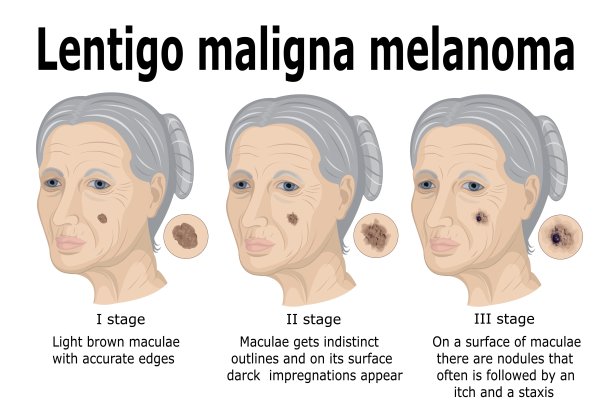 雀斑maligna黑色素瘤图片下载