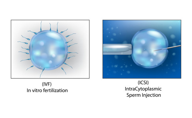 (ICSI)胞质内精子注射和体外受精。图片下载