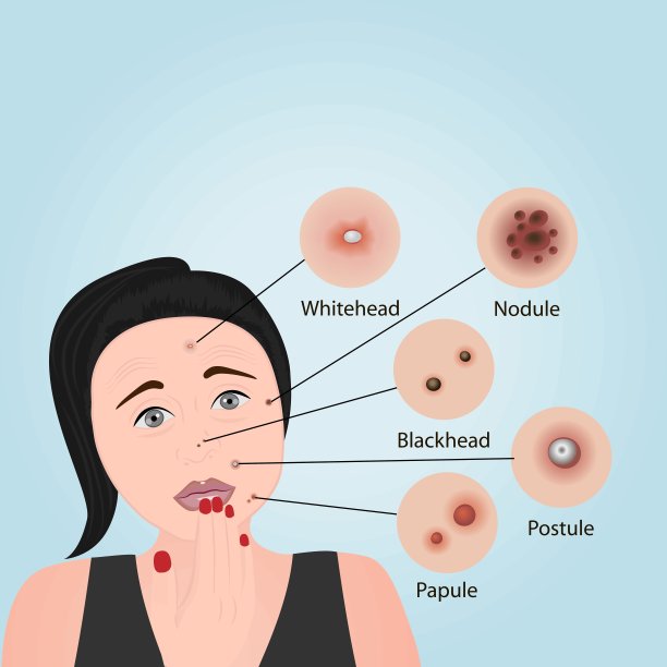 痤疮类型在脸上矢量插图。美容图片下载