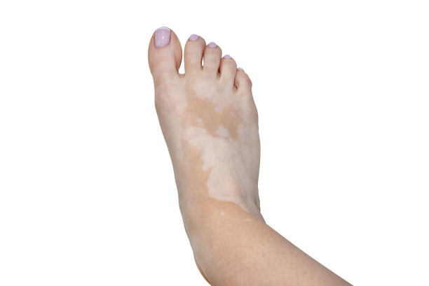 白癜风病右脚污点年轻白种人妇女，孤立在白色背景与剪切路径。图片下载