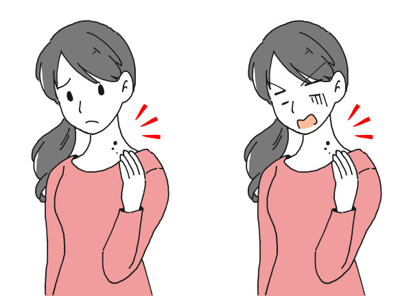 一个患有痣的女人的插图材料素材图片