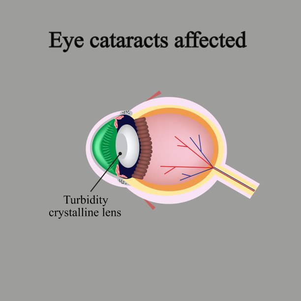 眼部结构受白内障影响图片下载