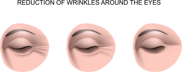 眼睛周围的皱纹图片下载