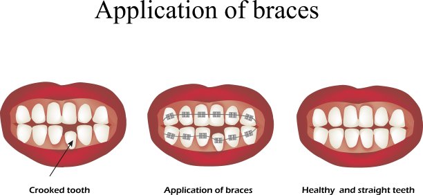 牙套的使用不正的牙齿矫正图片下载