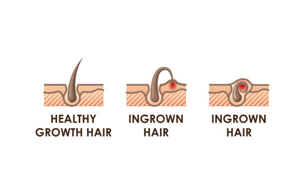 不同的脱毛方法。剃须刀，脱毛膏，脱毛器，脱毛蜡和激光。带有时间轴动作的脱毛类型[转换]图片下载