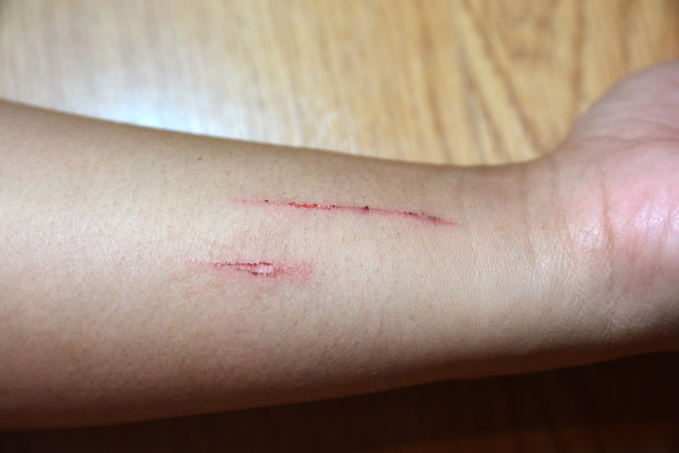 手上有伤疤，抓痕图片下载