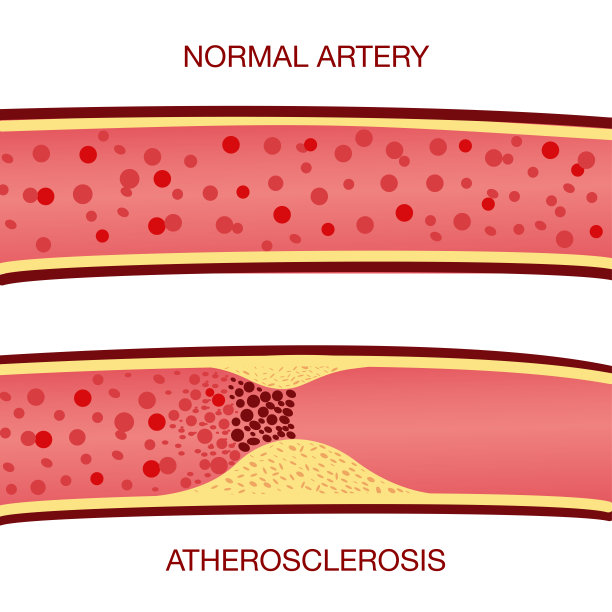 动脉粥样硬化中的胆固醇斑块图片下载