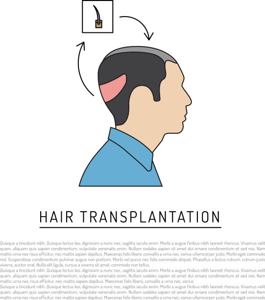 毛发移植图片下载