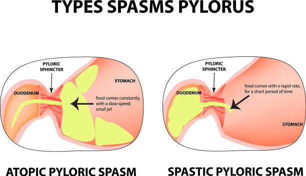 幽门痉挛的类型幽门痉挛图片下载