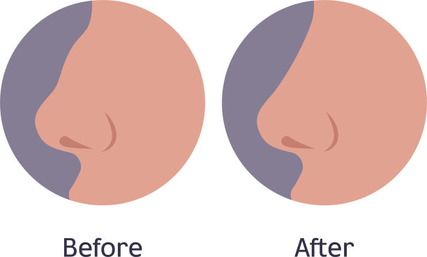 鼻整形手术前后图片下载