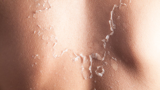 晒伤后皮肤脱皮的男人。图片下载