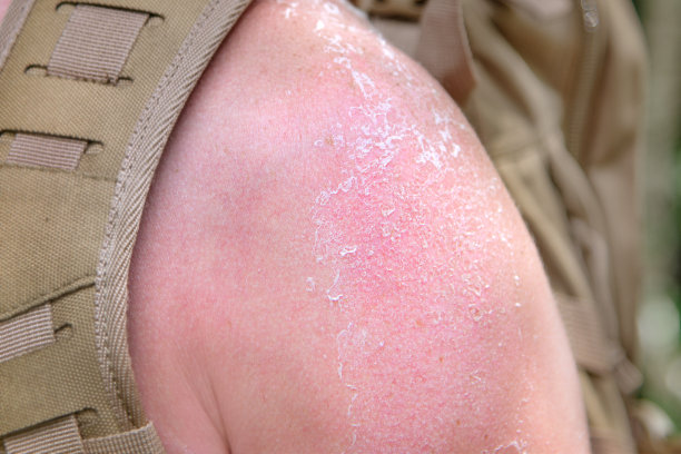 晒伤和肩膀皮肤脱落图片下载