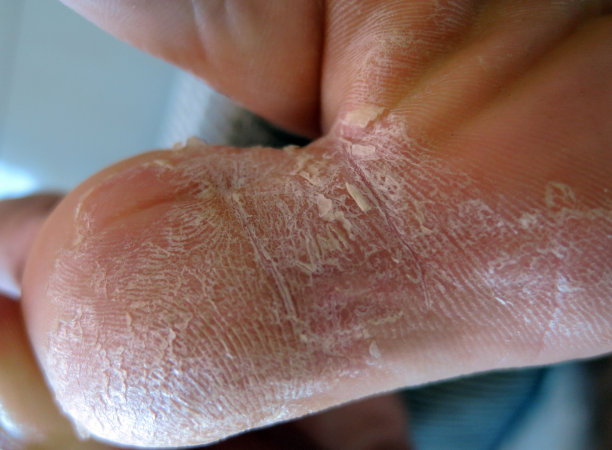 甲真菌病，也称为脚癣，是一种真菌感染的指甲。图片下载