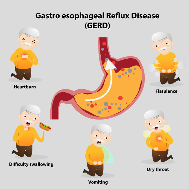 胃食管反流病gerd图片下载