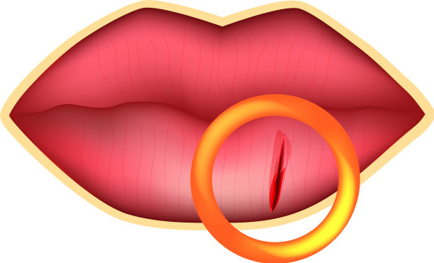 嘴唇干裂信息图图片下载