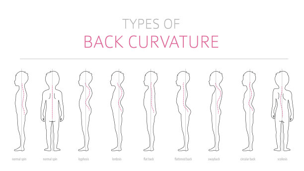 类型儿童背部弯曲医学疾病图片下载