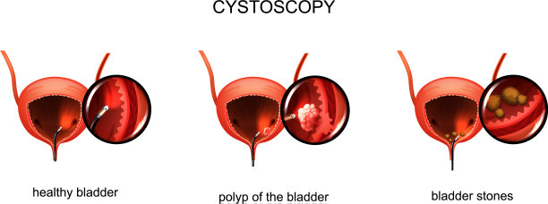 膀胱镜检查膀胱结石及息肉图片下载