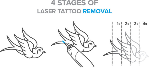 4个阶段的激光纹身去除图片下载